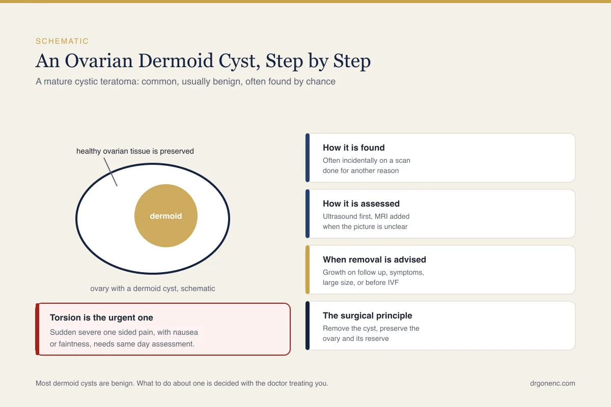 Ovarian dermoid cyst explained: what it is, how it is found and when it needs treatment