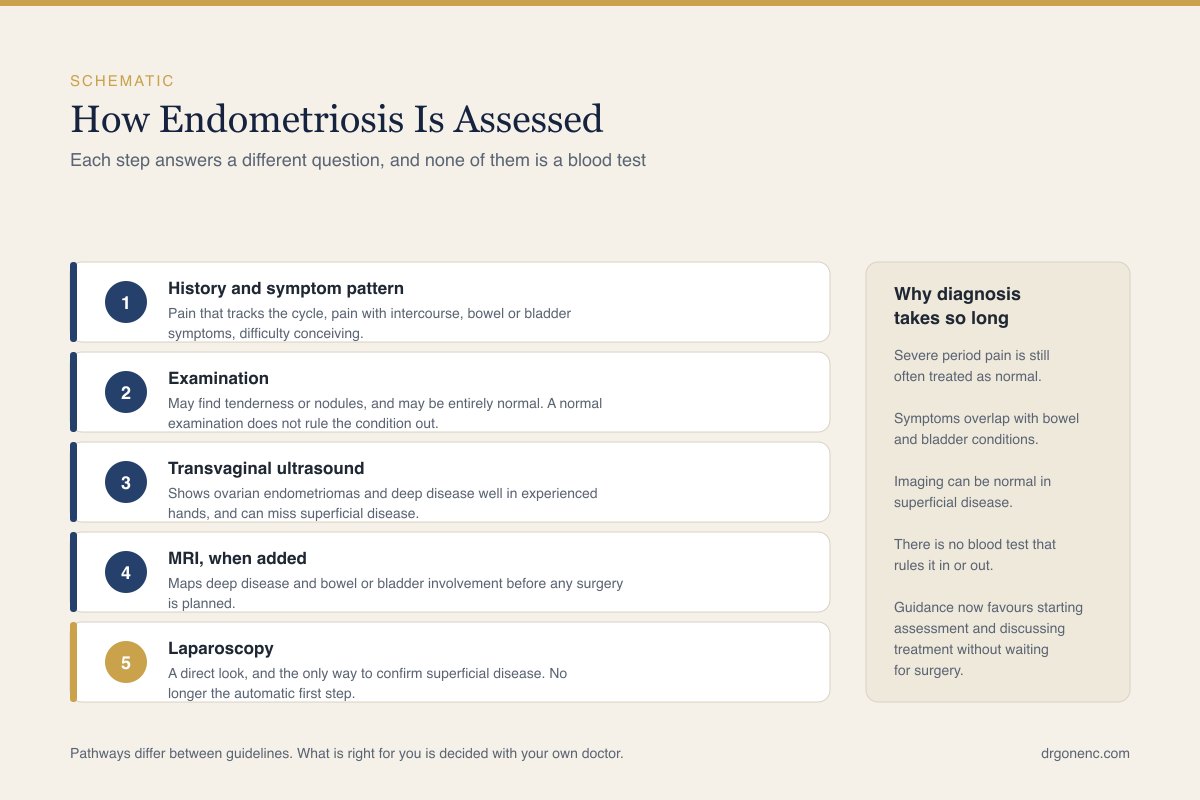 Schematic drawing illustrating the assessment of suspected endometriosis in the female pelvis