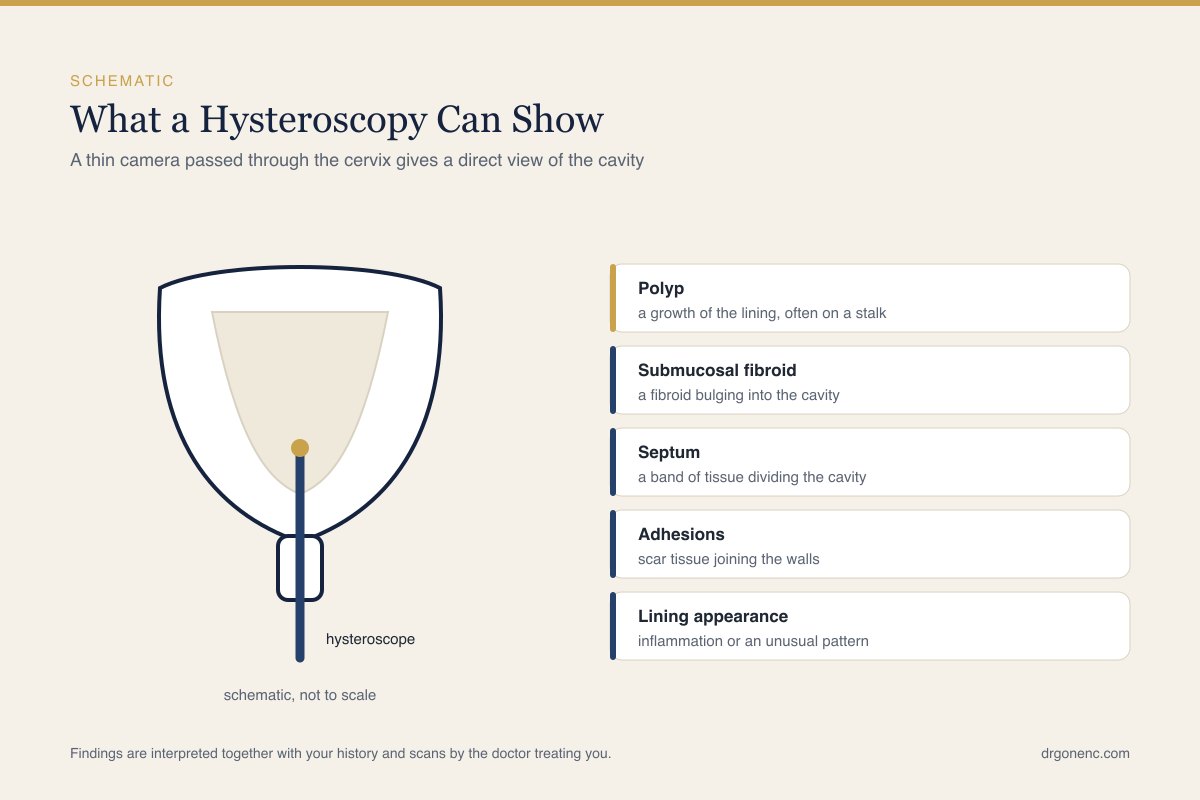 Schematic drawing of a thin hysteroscope passed through the cervix into the uterine cavity, beside a labelled list of what the examination can show: a polyp, a submucosal fibroid, a septum, adhesions and the appearance of the lining