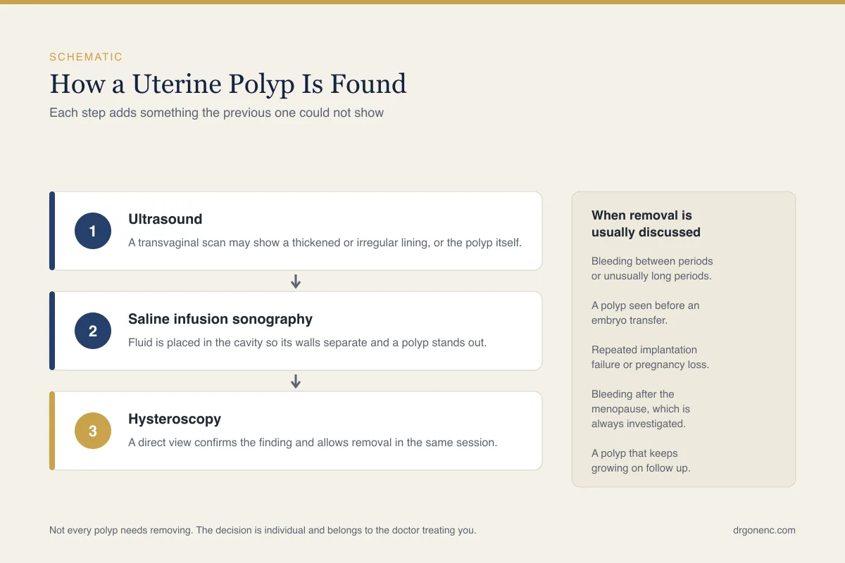 Uterine polyps and fertility: endometrial polyps, symptoms and removal